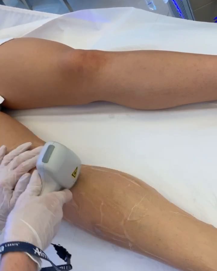 The handpiece guided along the forearm