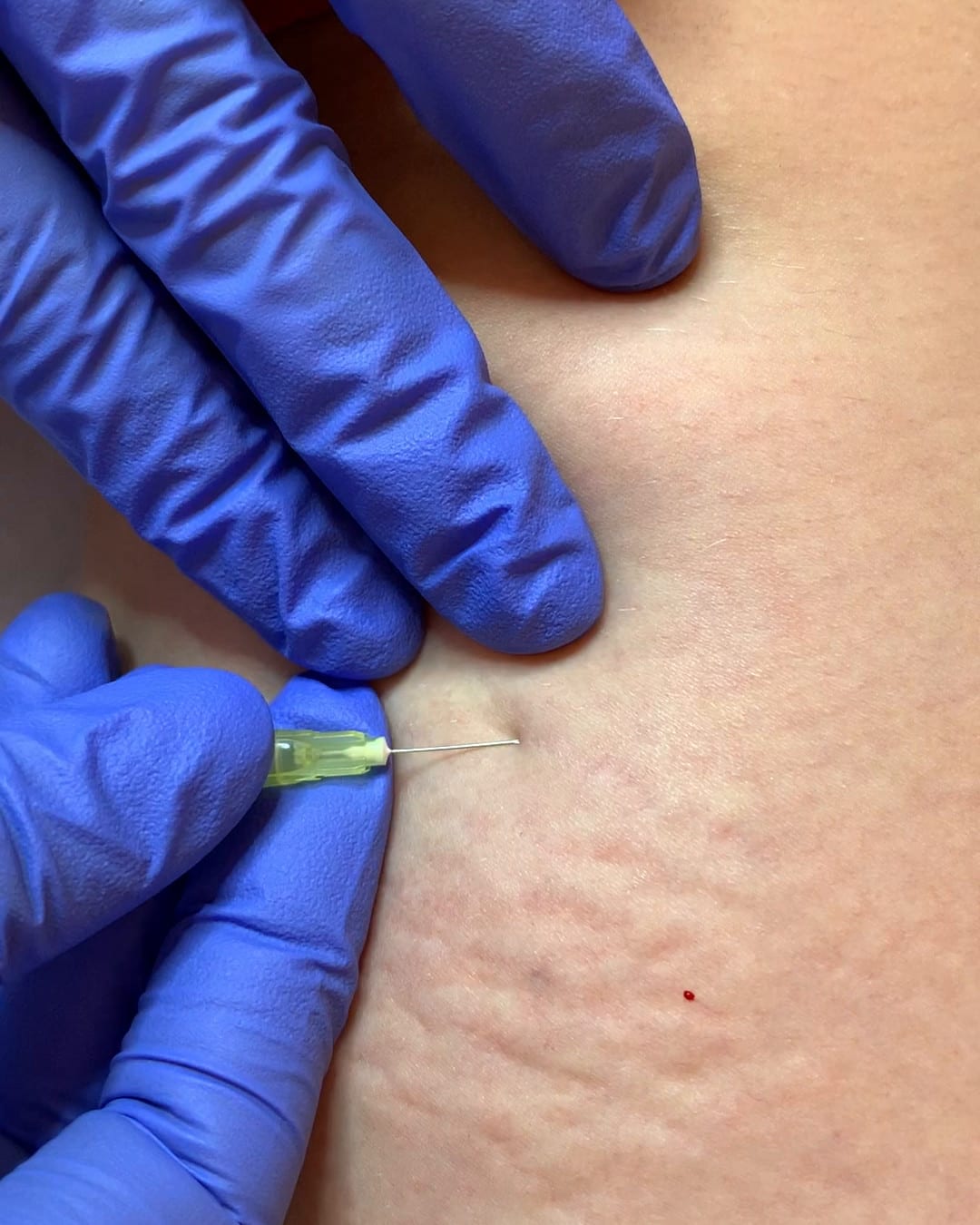 The needle placed under the skin — the start of delivery