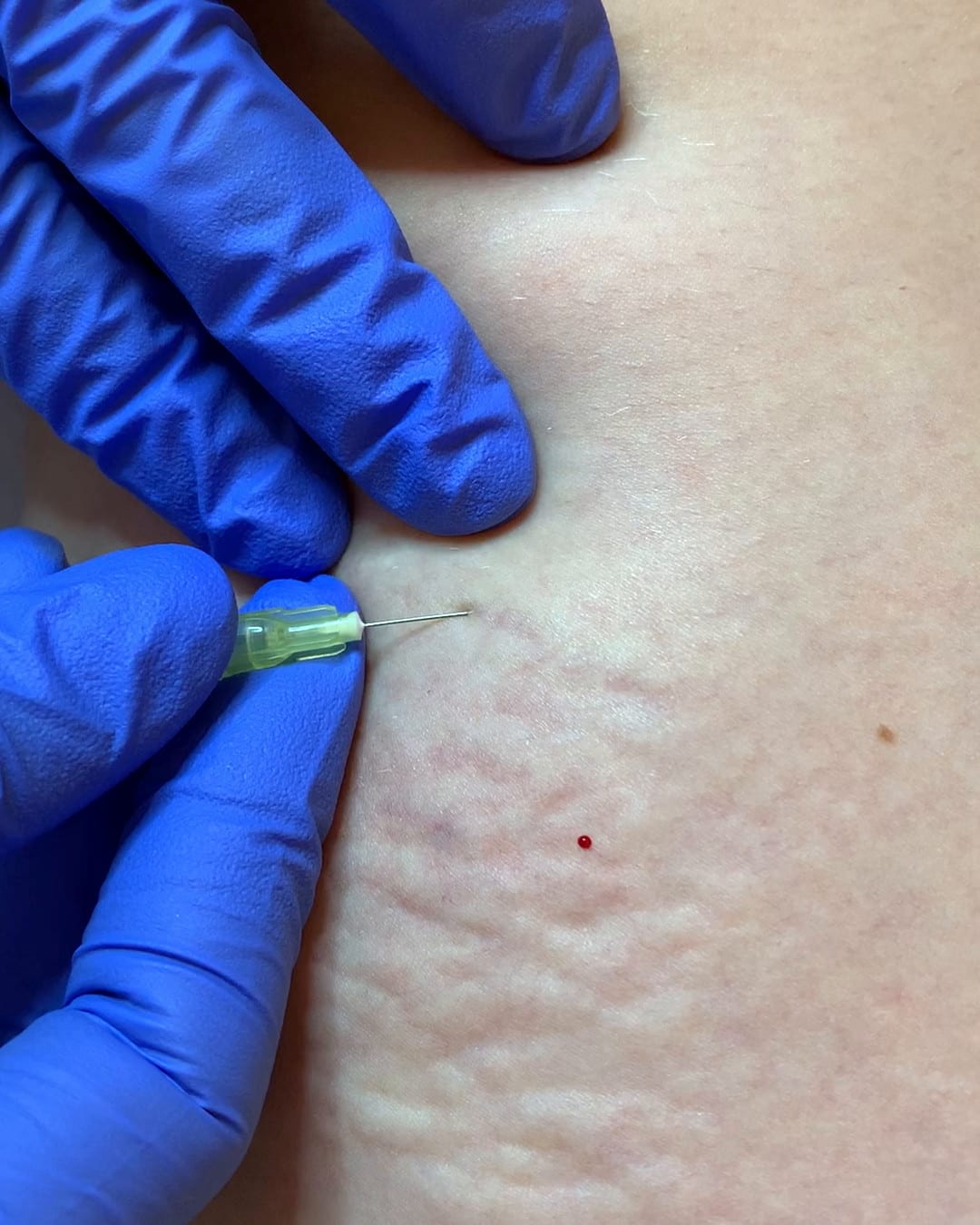 The gas spreads through the tissue — the skin lifts locally