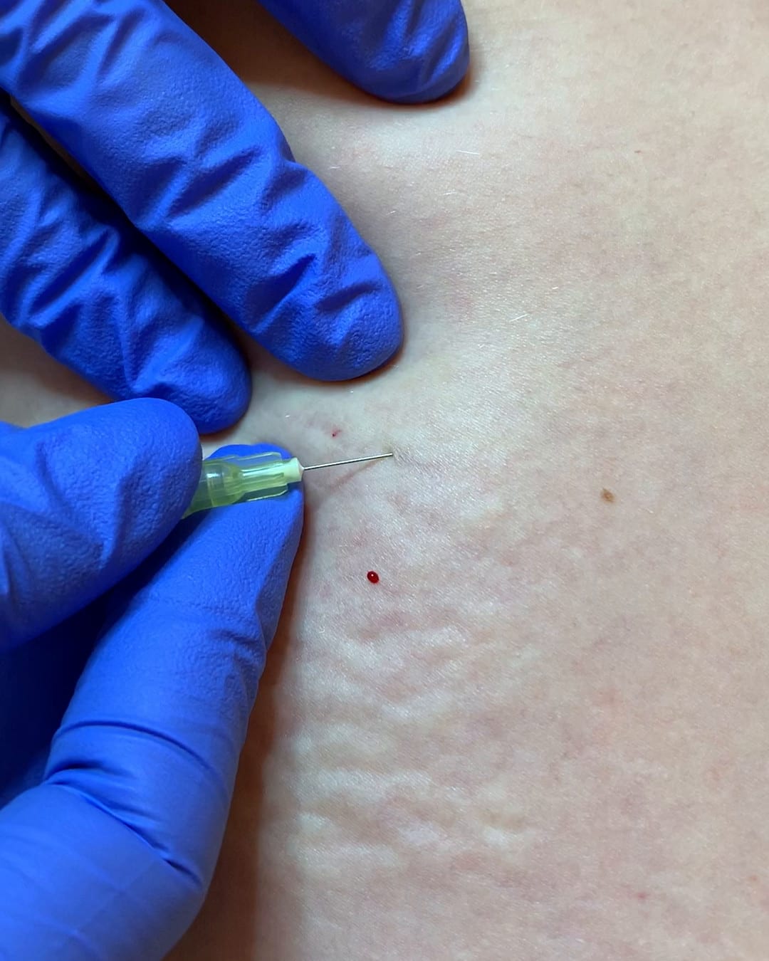 The puncture mark immediately after delivery