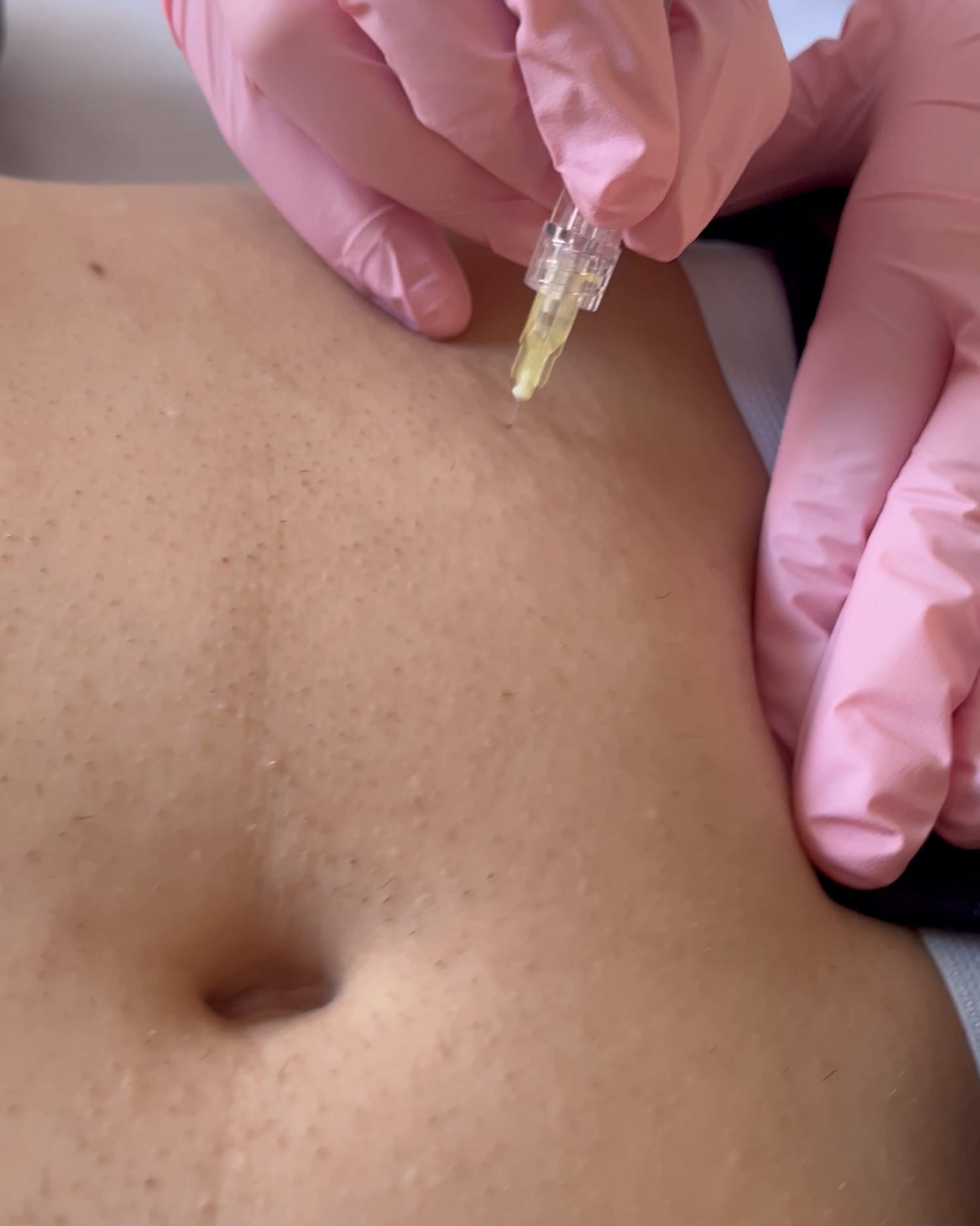 Delivery into the abdominal wall — close-up of the moment of entry