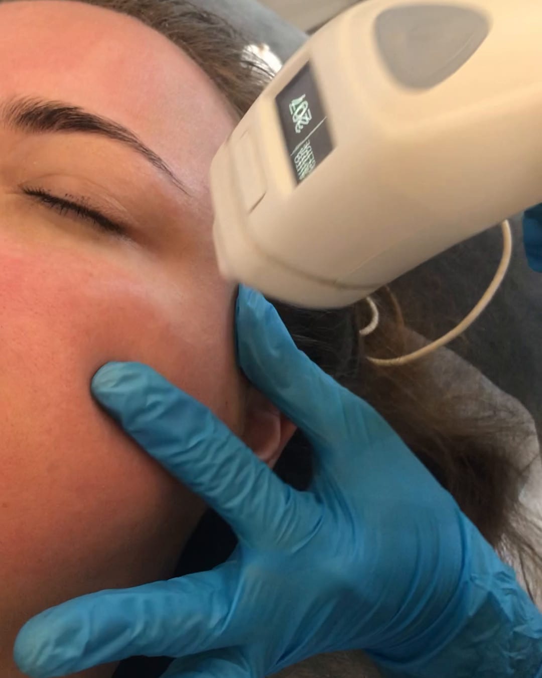 The handpiece on the neck — close-up of the skin during the treatment