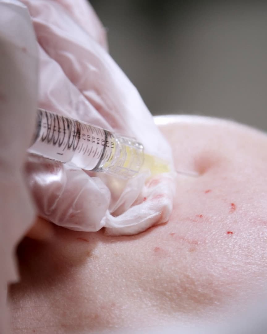 Puncture marks immediately after the injections