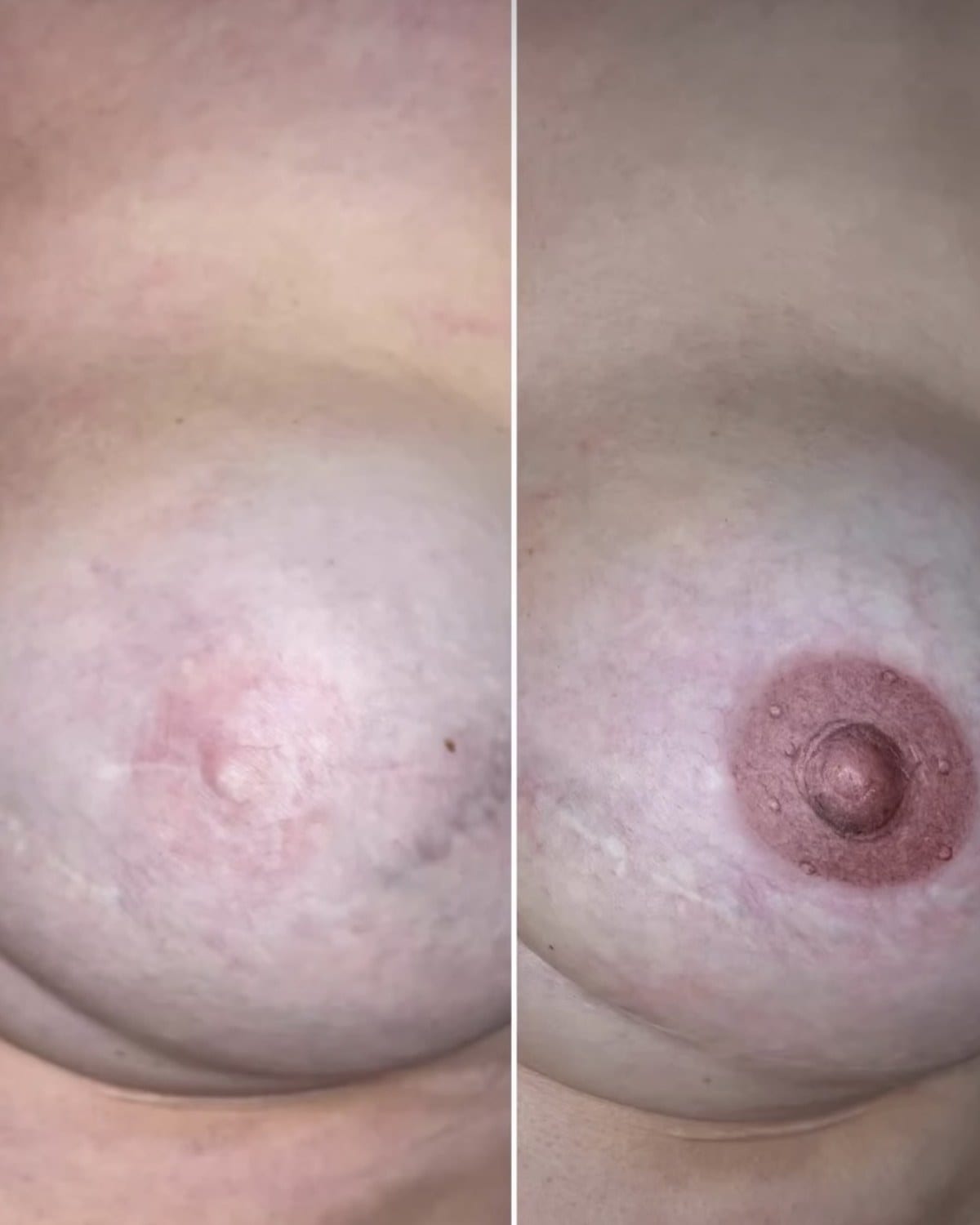Mikropigmentacja medyczna — rekonstrukcja po mastektomii