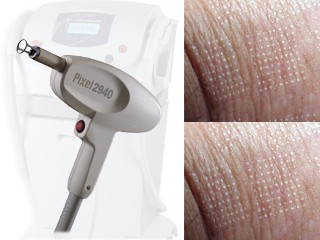 PIXEL – REMOVAL OF SCARS, STRETCH MARKS, DISCOLORATIONS AND WRINKLES