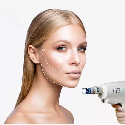 Clearlift – non-ablative lifting