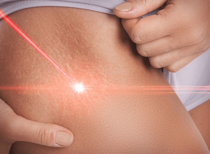 Czy laserowe usuwanie rozstępów jest skuteczne, laser removal of stretch marks