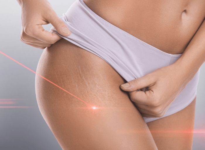 Is laser stretch mark removal effective?
