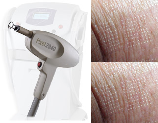 PIXEL – REMOVAL OF SCARS, STRETCH MARKS, DISCOLORATIONS AND WRINKLES