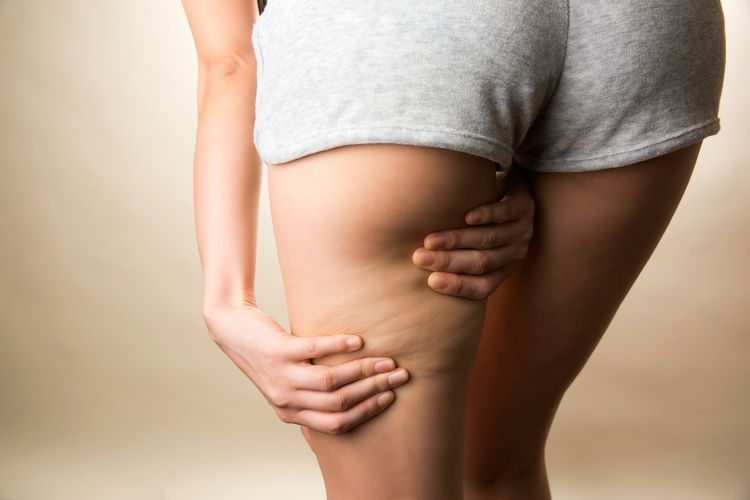 Cellulite? – It is not a problem. Check the best anti-cellulite treatments