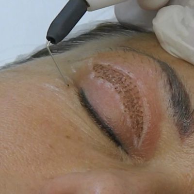 PLASMA IQ – Laser eyelid lifting without scalpel