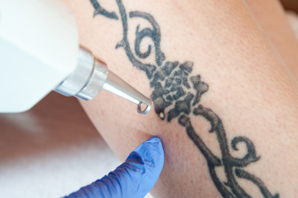 laserowe usuwanie tatuażu