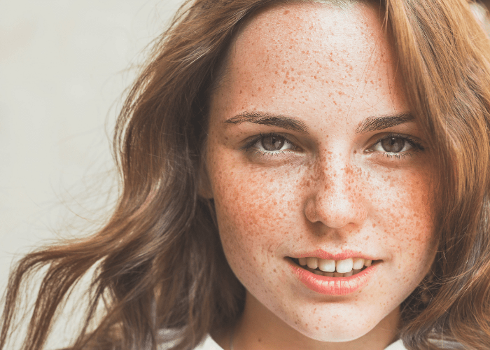 Jak usunąć piegi, How to remove freckles