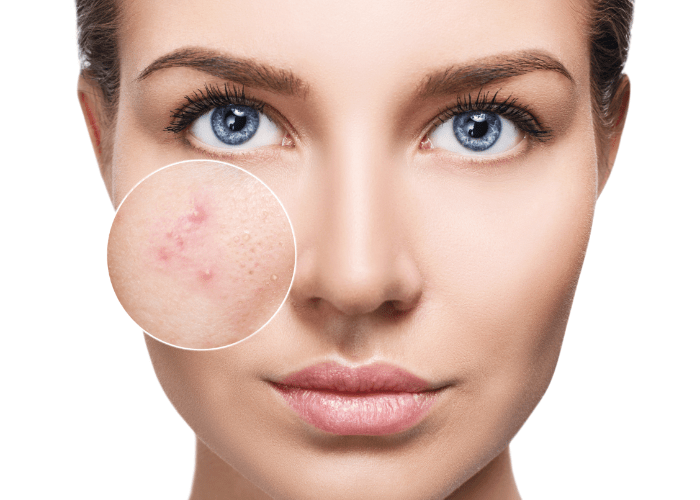 Rozszerzone pory trądzik wypryski, Extended pores of acne eczema
