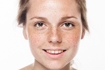 LASER REMOVAL OF DISCOLORATIONS, STAINS, FRECKLES