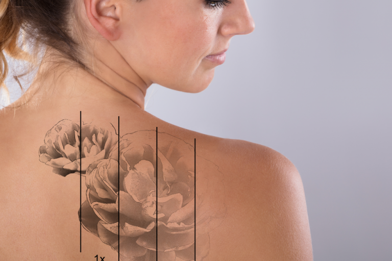 Laser tattoo removal without secrets