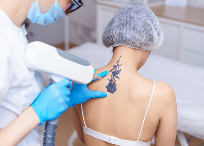usuwanie tatuażu