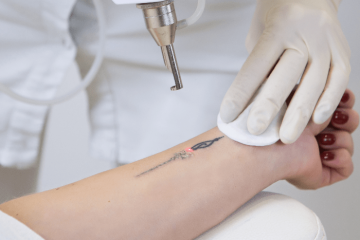 Laserowe usuwanie tatuażu Qswitch